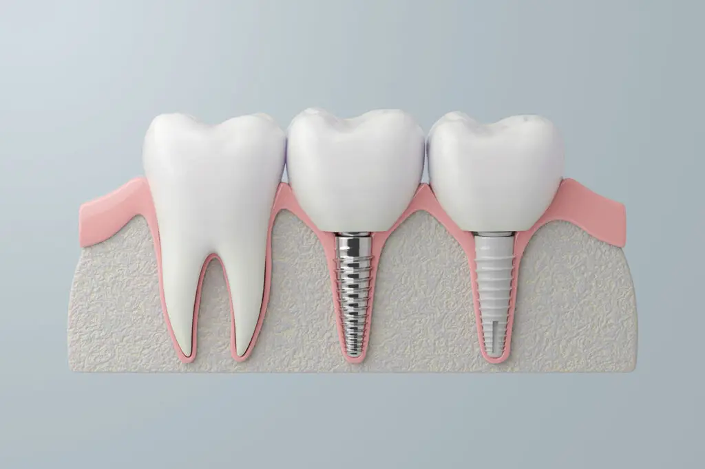 Am-I-a-Good-Candidate-for-Dental-Implants-in-Southport-NC Am I a Good Candidate for Dental Implants in Southport, NC?